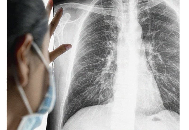 ung thư phổi phát hiện sớm có chữa được không