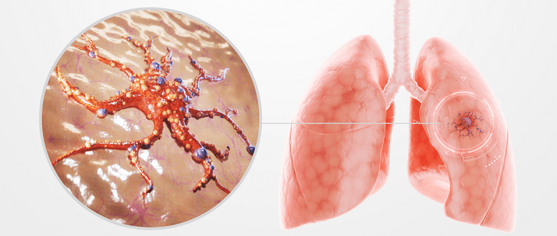 ung thư phổi không tế bào nhỏ
