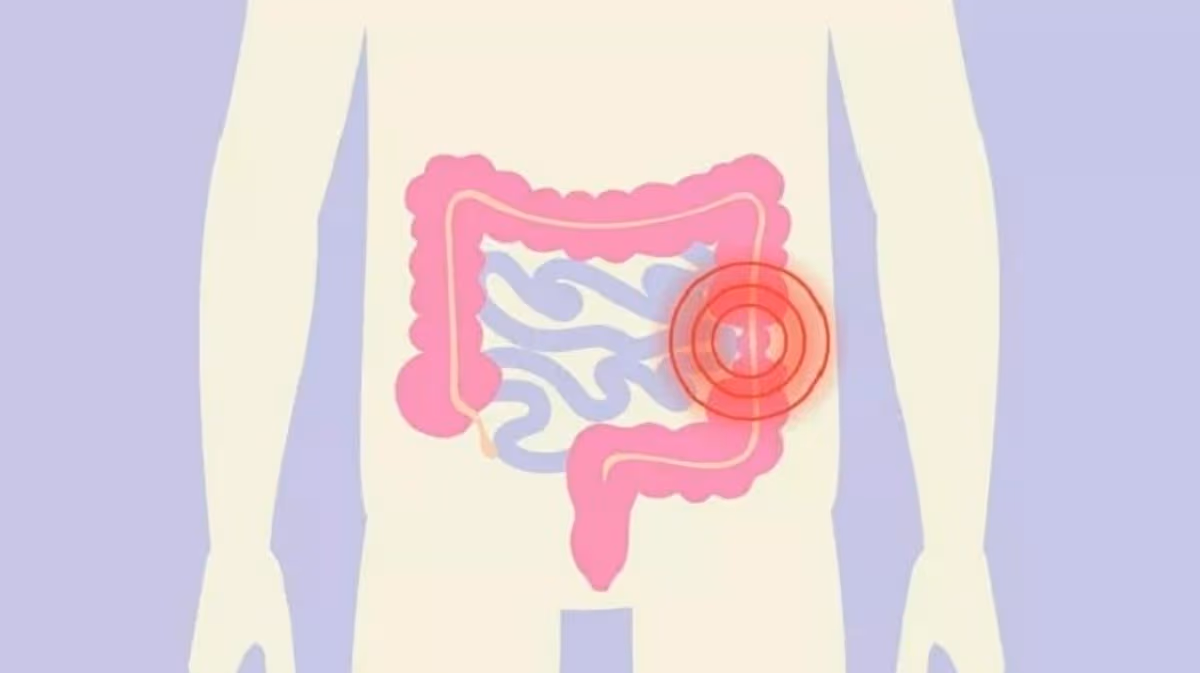 Hội chứng ruột kích thích và trào ngược dạ dày có khác nhau không?