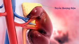 Phác đồ điều trị suy tuyến thượng thận mạn