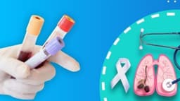 Chỉ số Cyfra 21-1 tăng bao nhiêu là ung thư phổi?