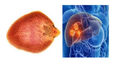 Điều trị áp xe gan do sán lá gan lớn