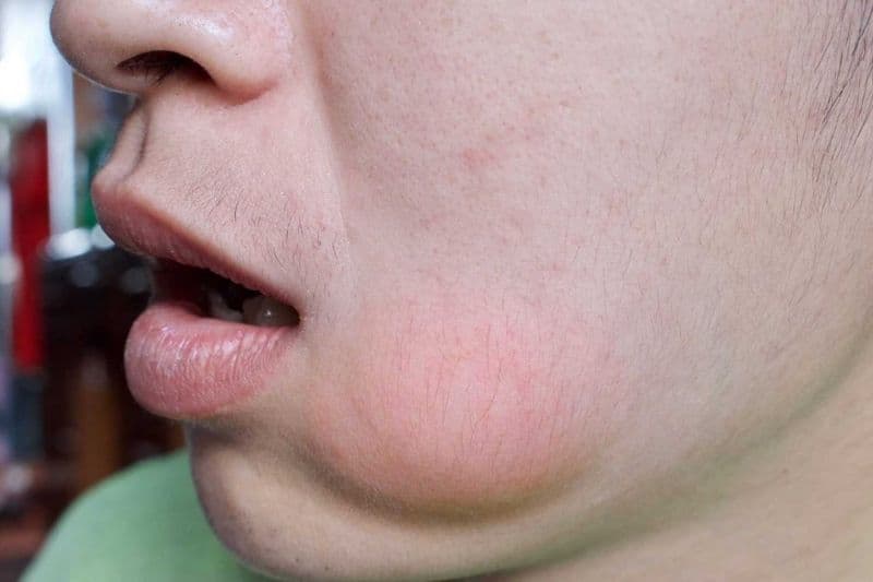 áp xe má có nguy hiểm không