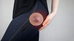 Cảnh giác ổ mủ dưới da do áp xe mụn nhọt ở mông