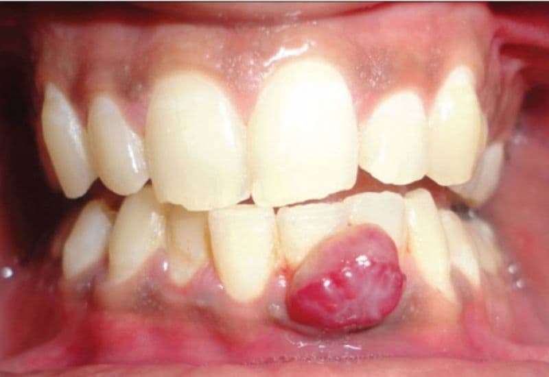 áp xe răng để lâu có sao không