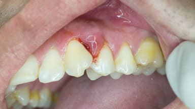 Áp xe răng là gì? Các vị trí áp xe răng thường gặp