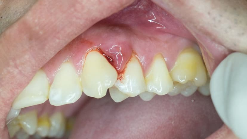 Áp xe răng là gì? Các vị trí áp xe răng thường gặp