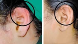 Áp xe tai khi xỏ khuyên: Chớ chủ quan