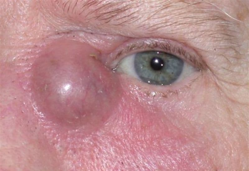 áp xe tuyến lệ là gì