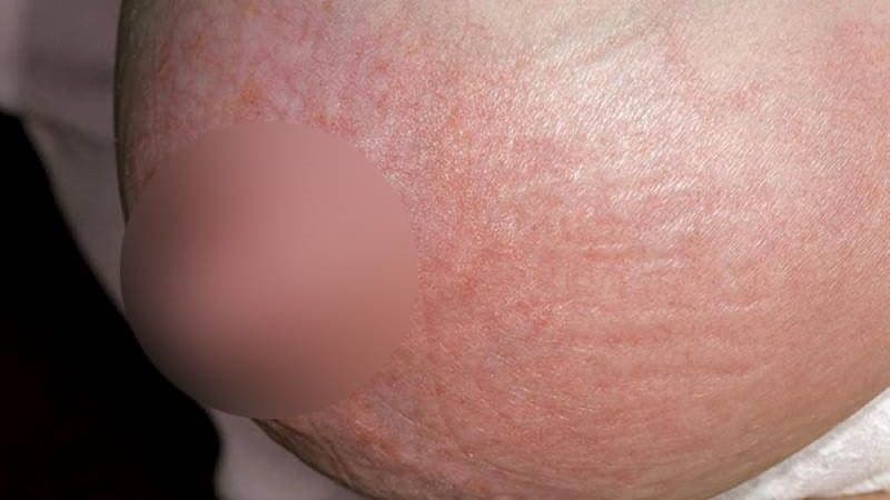 áp xe vú do sinh vật kỵ khí