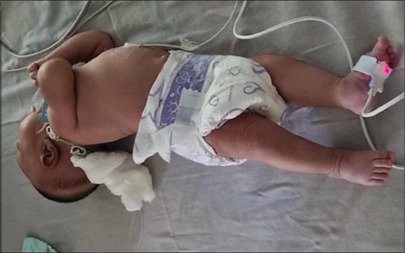 dấu hiệu tăng trương lực cơ ở trẻ sơ sinh