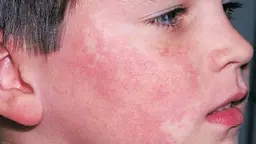 Bệnh lupus ban đỏ có chết không? Liệu sống được bao nhiêu năm?