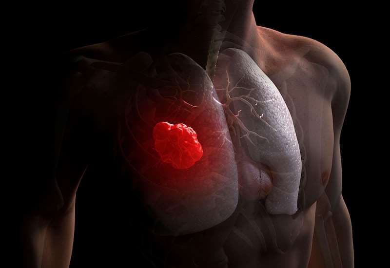 phác đồ điều trị ung thư phổi giai đoạn 3