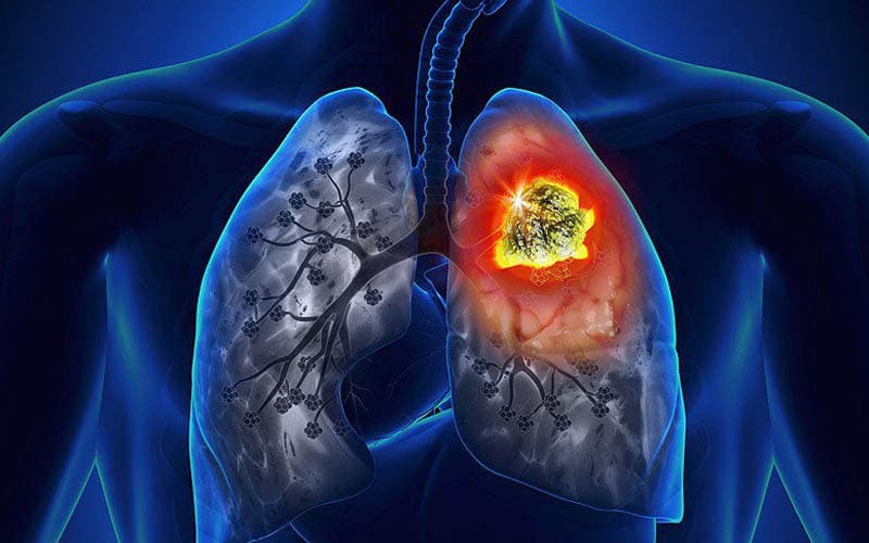 bệnh hô hấp do ô nhiễm môi trường