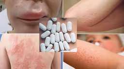 Bị dị ứng thuốc kháng sinh bao lâu thì khỏi?