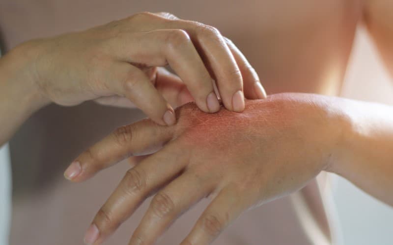 cách chữa dị ứng thuốc kháng sinh tại nhà