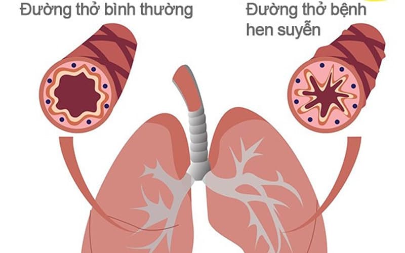 bệnh hô hấp do ô nhiễm môi trường