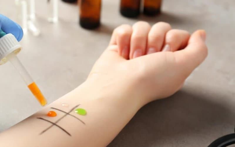 cách chữa dị ứng thuốc kháng sinh tại nhà