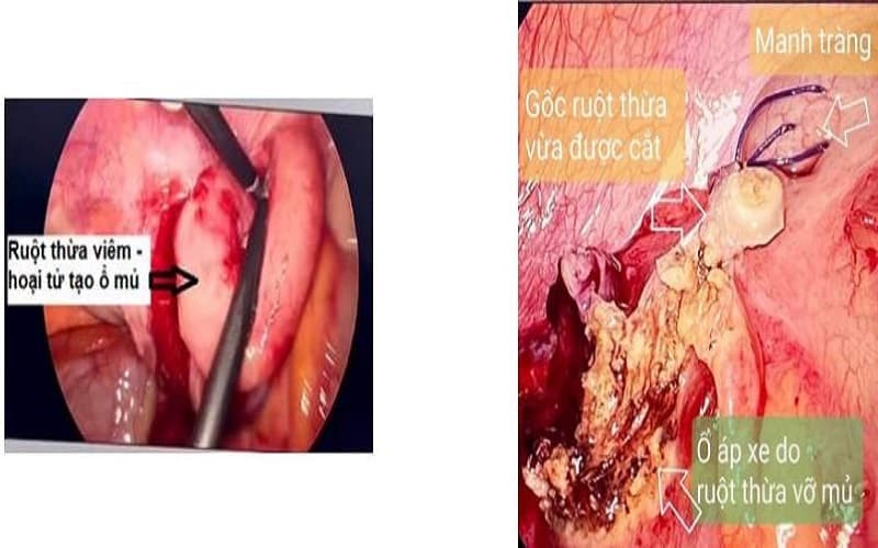 phác đồ điều trị áp xe ruột thừa