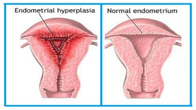 Cách điều trị tăng sinh nội mạc tử cung