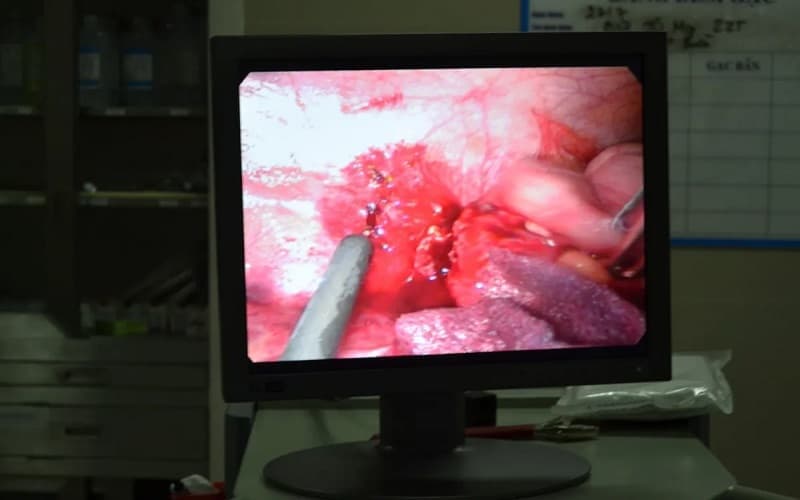 phác đồ điều trị áp xe ruột thừa