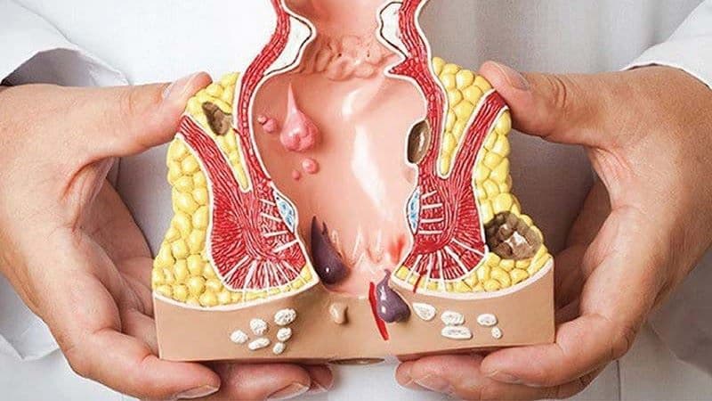 cơ vòng hậu môn yếu