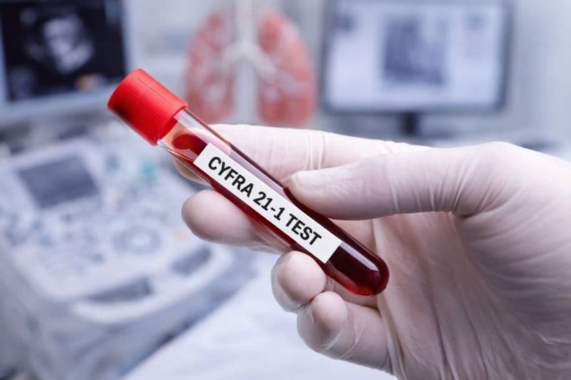 cyfra 21-1 tăng bao nhiêu là ung thư phổi