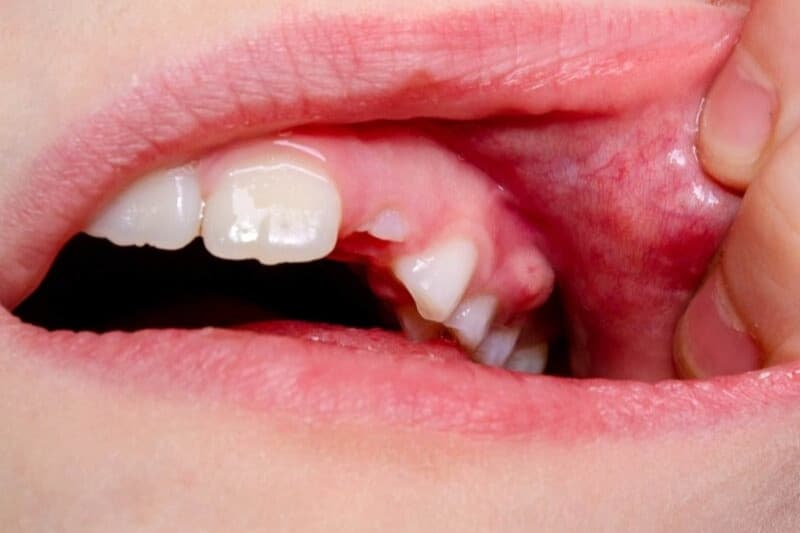 áp xe má có nguy hiểm không