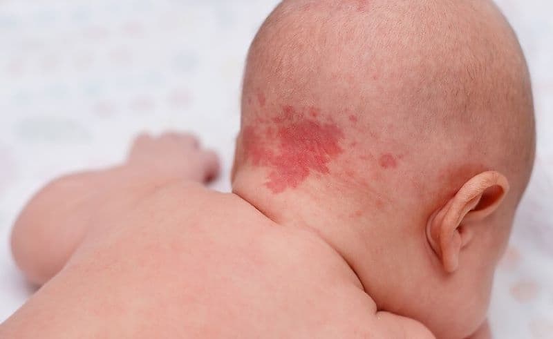 cách nhận biết u máu ở trẻ sơ sinh