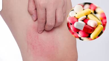 Vì sao dị ứng thuốc kháng sinh gây ngứa?