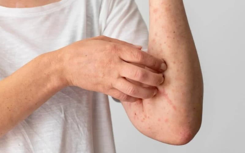 cách điều trị dị ứng thuốc kháng sinh