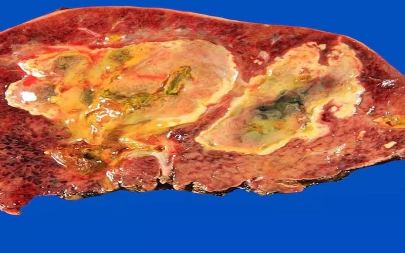 phác đồ điều trị áp xe gan bộ y tế