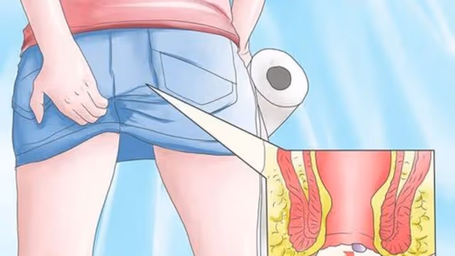 Làm gì khi hậu môn ẩm ướt ngứa ngáy?