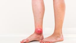 Các vị trí áp xe chân hay gặp và tình trạng nguy hiểm cần biết