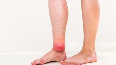 Các vị trí áp xe chân hay gặp và tình trạng nguy hiểm cần biết