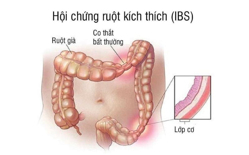 hội chứng ruột kích thích thể táo bón