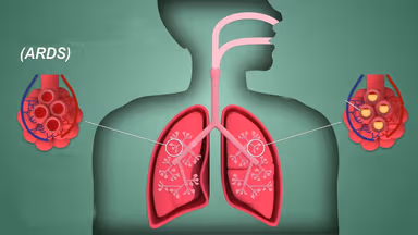 Hội chứng suy hô hấp cấp tiến triển ARDS