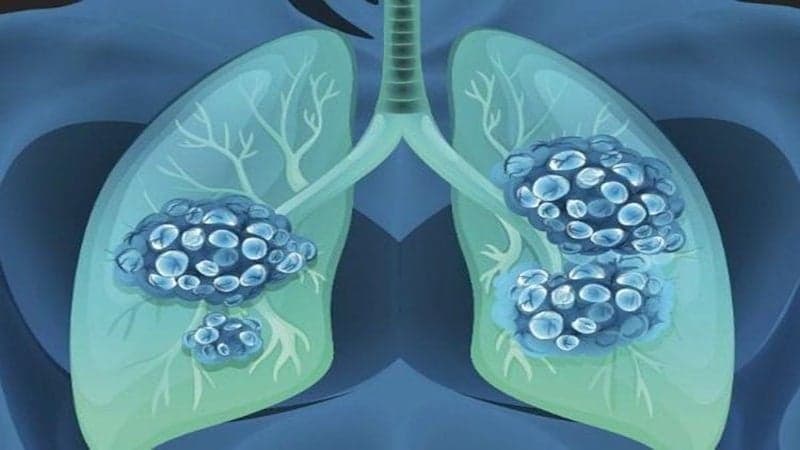 hội chứng suy hô hấp cấp tiến triển ards