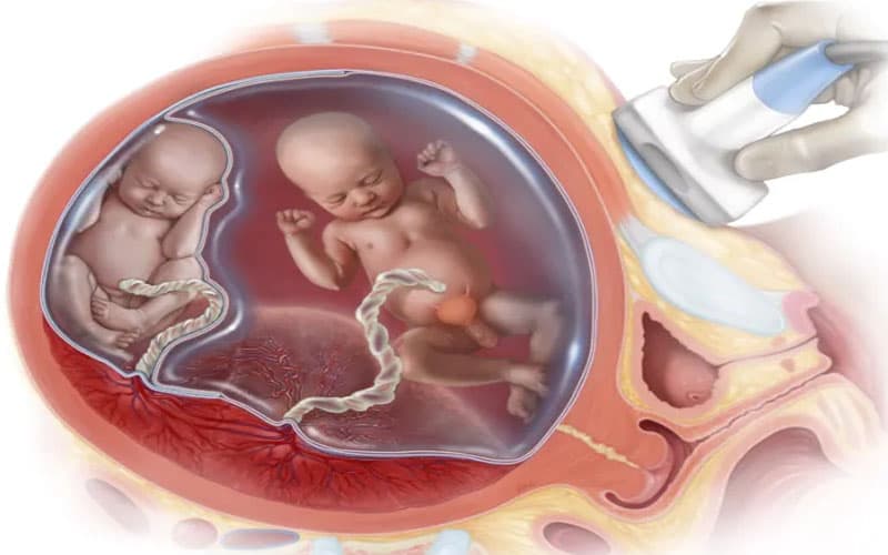 truyền máu song thai là gì?