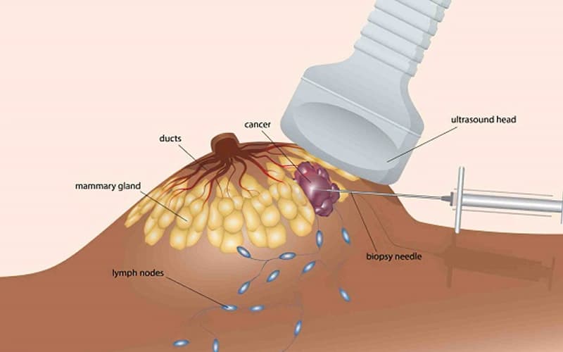 u lành tính có tăng sinh mạch máu không