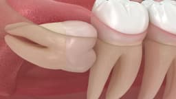 Làm sao để biết răng khôn mọc thẳng hay lệch?