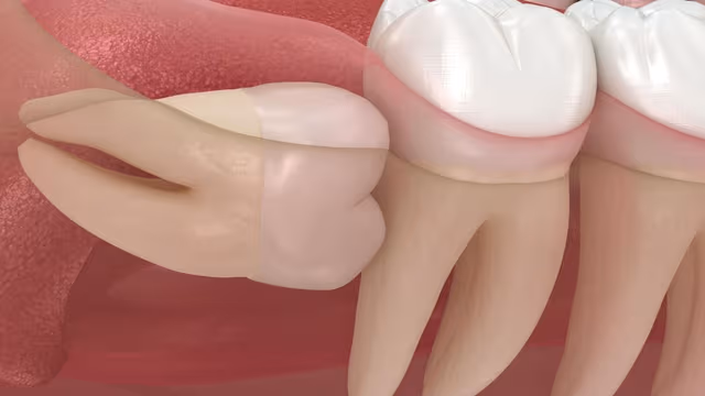 Làm sao để biết răng khôn mọc thẳng hay lệch?