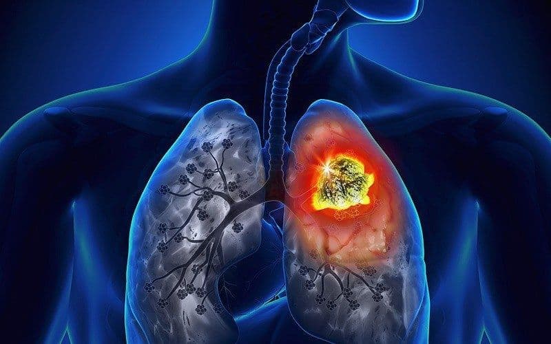 lao phổi có dẫn đến ung thư phổi không