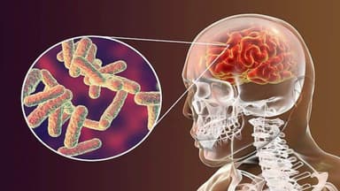 Liều Dexamethasone trong điều trị viêm màng não