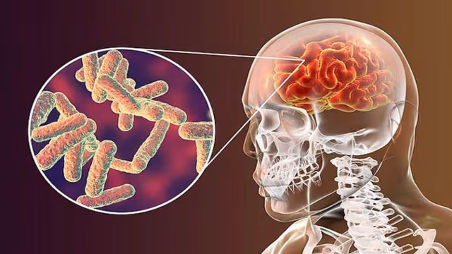 Liều Dexamethasone trong điều trị viêm màng não