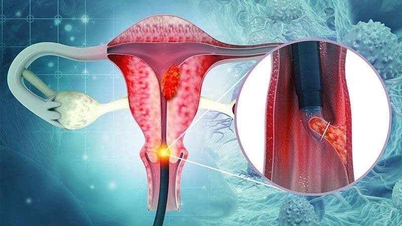 HPV có gây ung thư hậu môn không