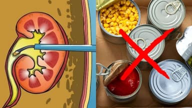 Sau khi tán sỏi niệu quản nên kiêng gì để mau hồi phục?