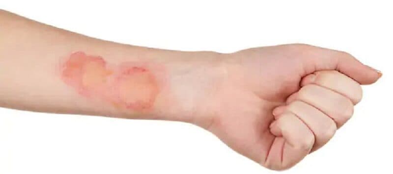 phát ban nhiễm trùng máu