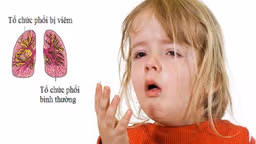 Nhiễm trùng phổi ở trẻ em có nguy hiểm không?