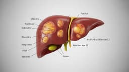 Phác đồ điều trị áp xe gan Bộ y tế